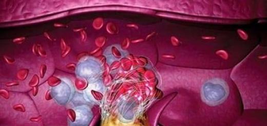 Тромбоэмболия легочной артерии (тэла): причины, признаки, терапия Лечить тромбоэмболию