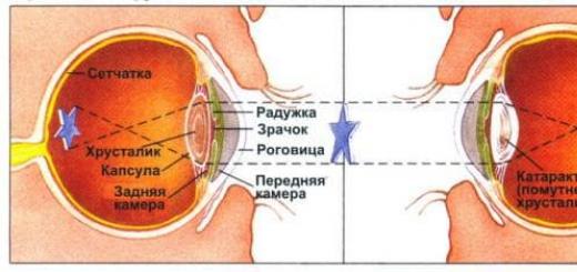 Виды катаракт, симптомы по которым можно распознать болезнь Катаракта симптомы и признаки